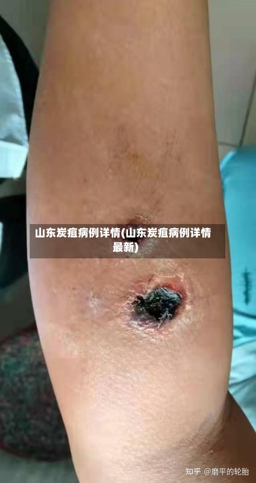 山东炭疽病例详情(山东炭疽病例详情最新)