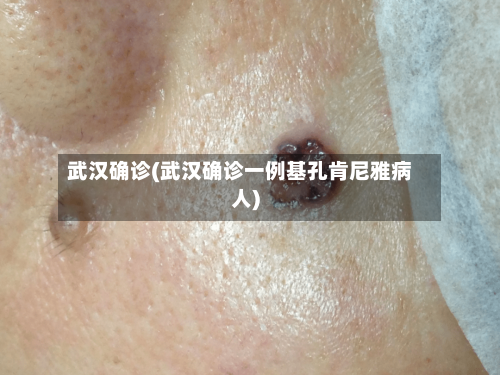 武汉确诊(武汉确诊一例基孔肯尼雅病人)-第2张图片